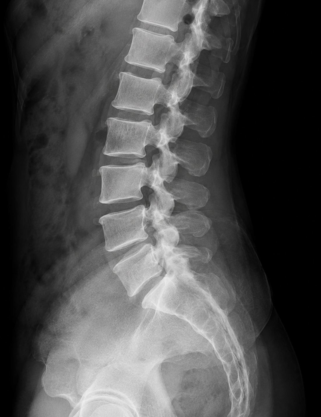 Lateral lumbar spine X-ray.